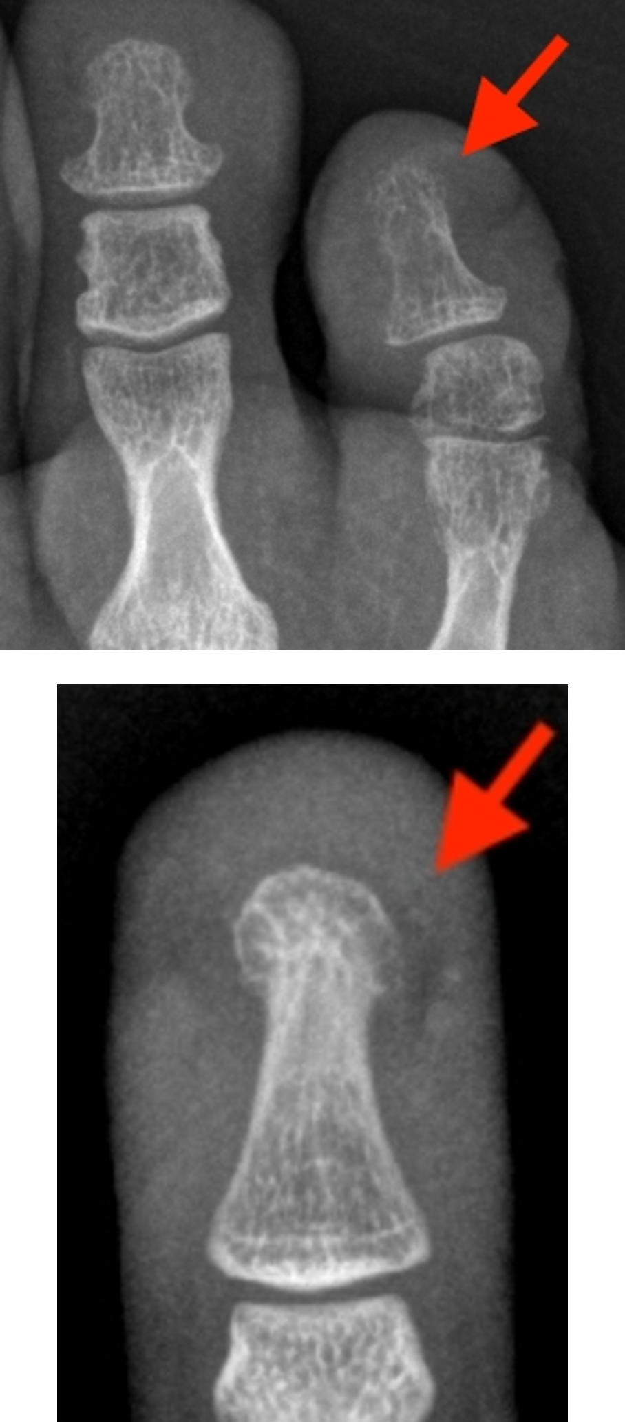 Acute Osteomyelitis 4