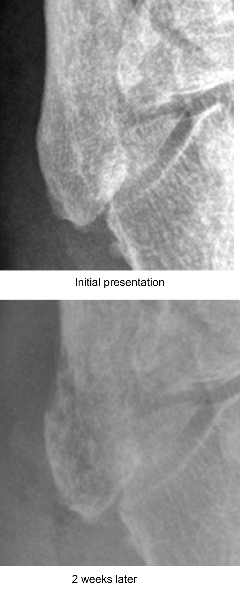 Acute Osteomyelitis 3