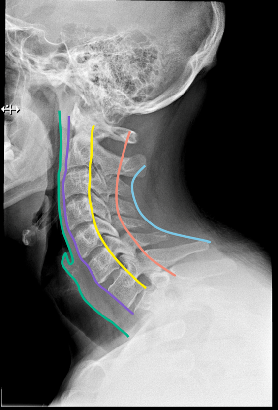 Cervical Spine 1