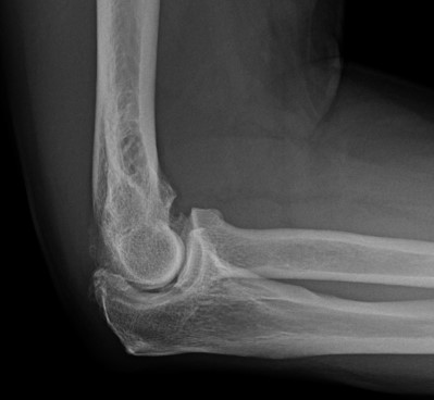Elbow Pain- Osteoarthritis