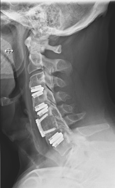 Postoperative Spine