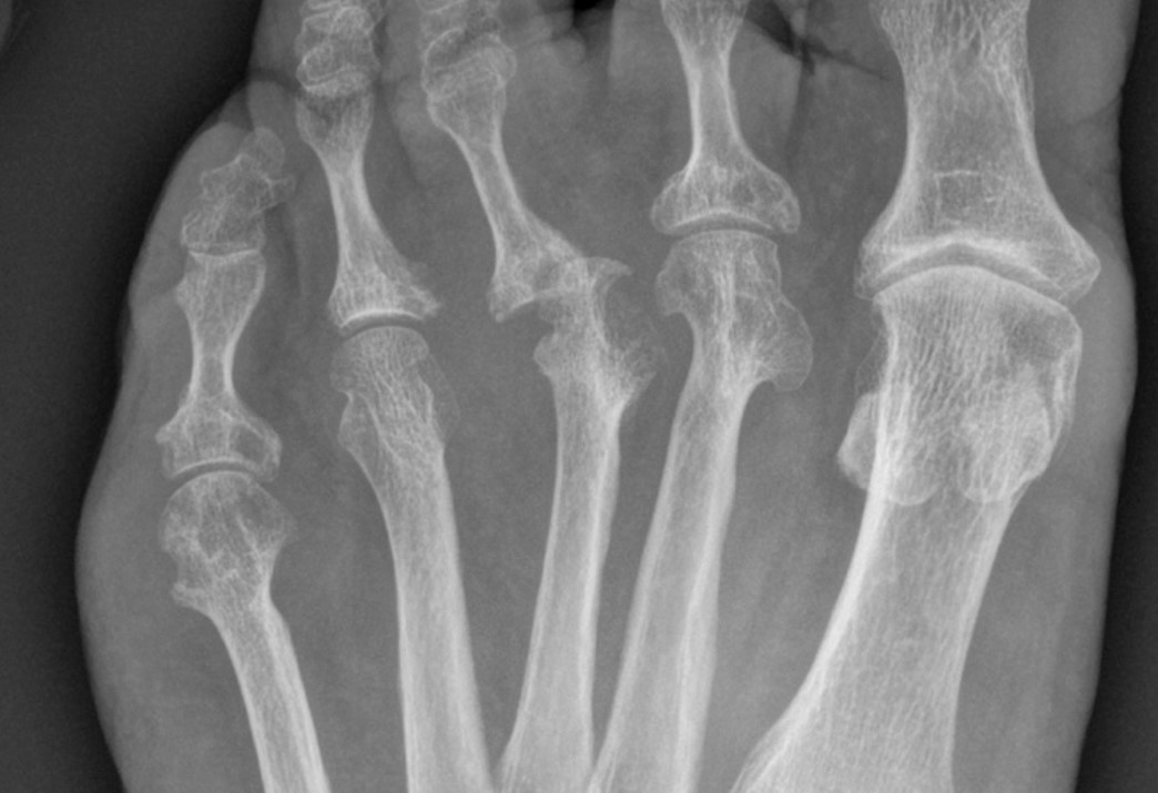 Foot Inflammatory Arthritis 1