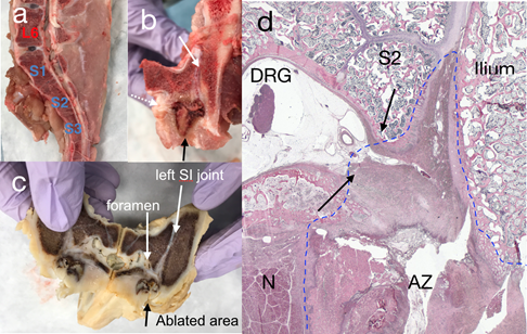 ablation